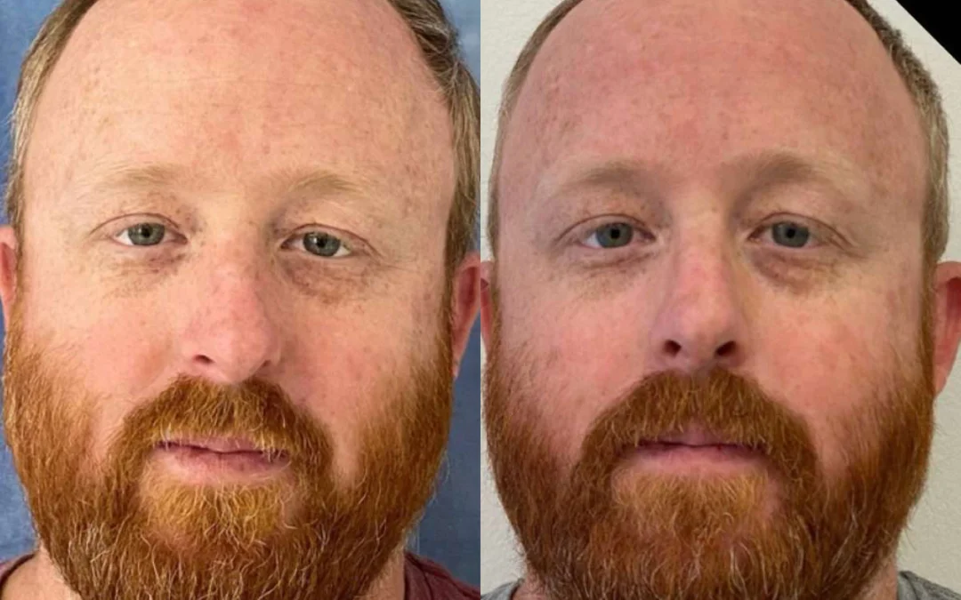 Rhinoplasty before and after photos by Dr. Demetri Arnaoutakis in Tampa, FL