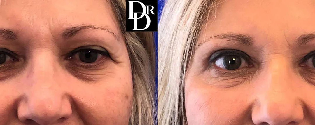 Eyelid Surgery before and after photos by Dr. Demetri Arnaoutakis in Tampa, FL