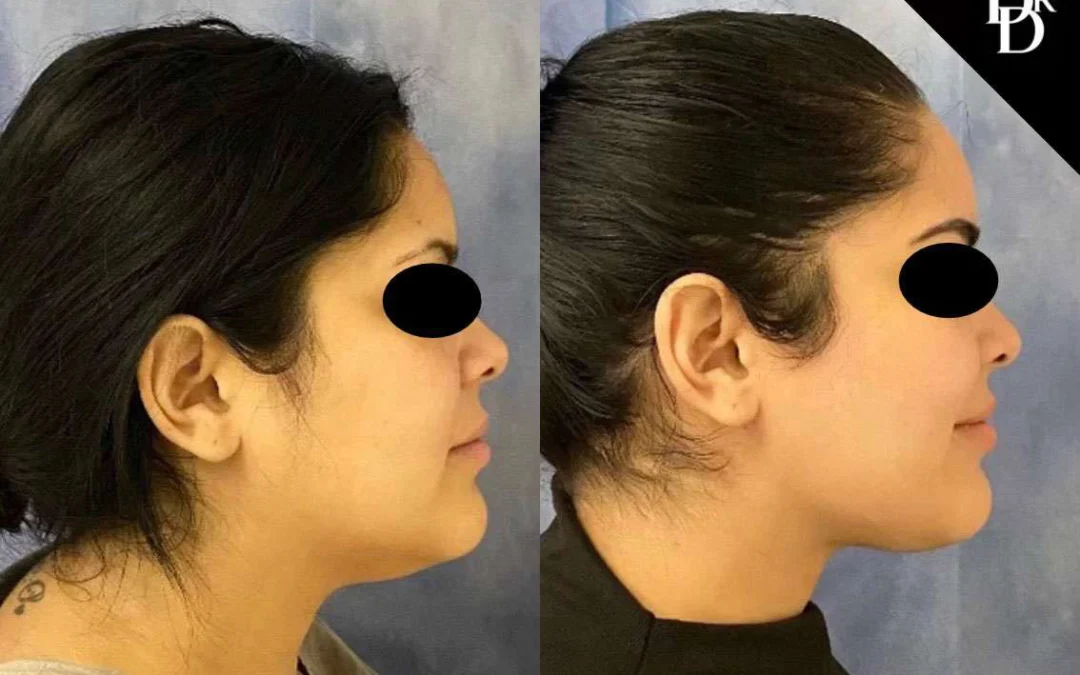 Neck Lift Before And After Photos By Dr. Demetri Arnaoutakis In Tampa, Fl