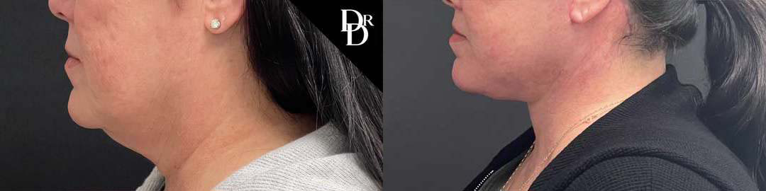 Neck Lift before and after photos by Dr. Demetri Arnaoutakis in Tampa, FL
