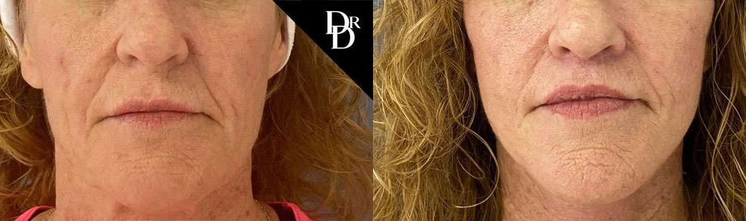 Lip Lift before and after photos by Dr. Demetri Arnaoutakis in Tampa, FL