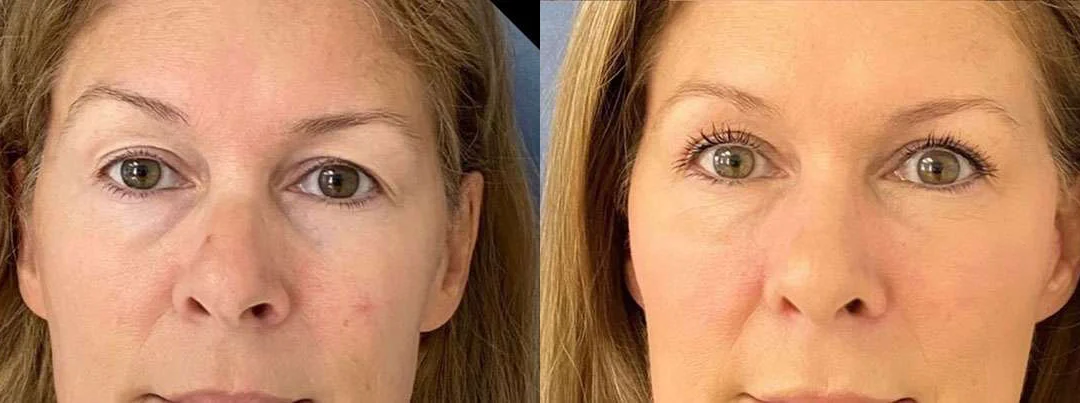 Eyelid Surgery before and after photos by Dr. Demetri Arnaoutakis in Tampa, FL