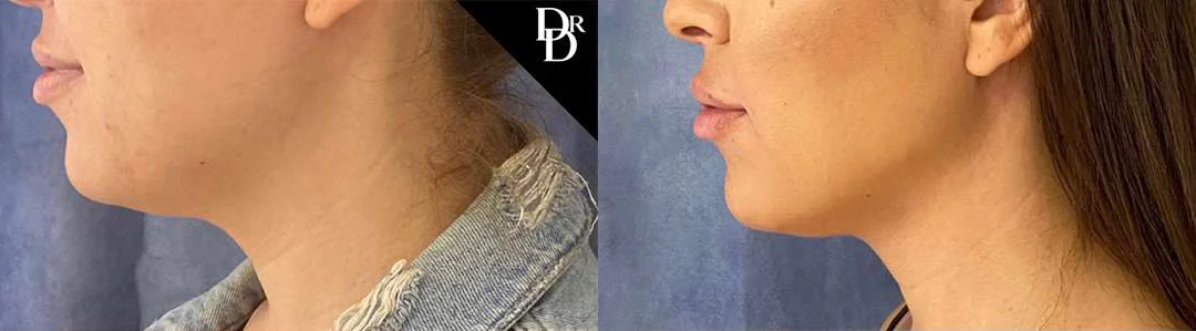 Facetite Before And After Photos By Dr. Demetri Arnaoutakis In Tampa, Fl