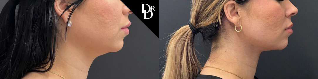 Neck Lift before and after photos by Dr. Demetri Arnaoutakis in Tampa, FL