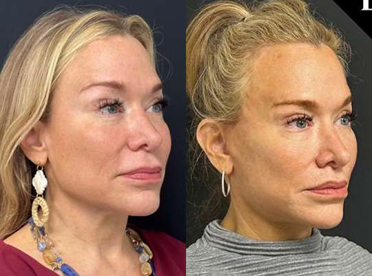 Facelift Before And After Photos By Dr. Demetri Arnaoutakis In Tampa, Fl