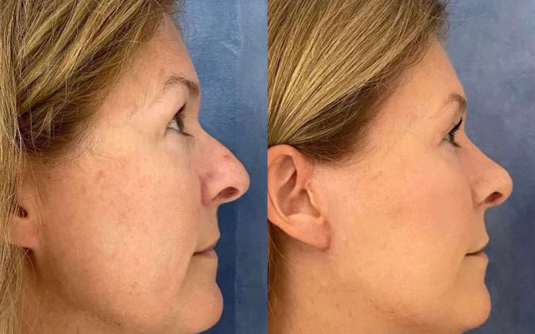 Rhinoplasty before and after photos by Dr. Demetri Arnaoutakis in Tampa, FL