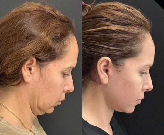 Facelift Before And After Photos By Dr. Demetri Arnaoutakis In Tampa, Fl