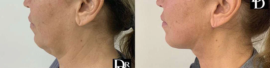 Facetite Before And After Photos By Dr. Demetri Arnaoutakis In Tampa, Fl