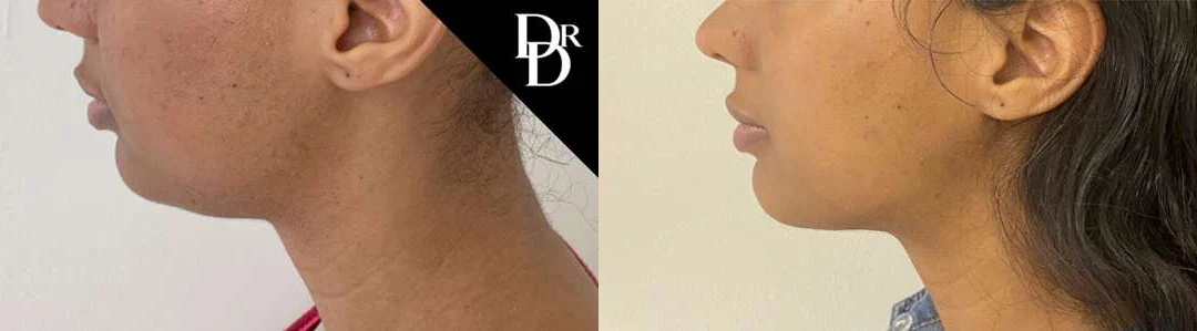 Neck Lift Before And After Photos By Dr. Demetri Arnaoutakis In Tampa, Fl