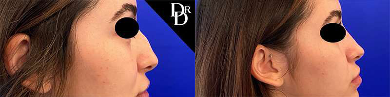 Rhinoplasty before and after photos by Dr. Demetri Arnaoutakis in Tampa, FL