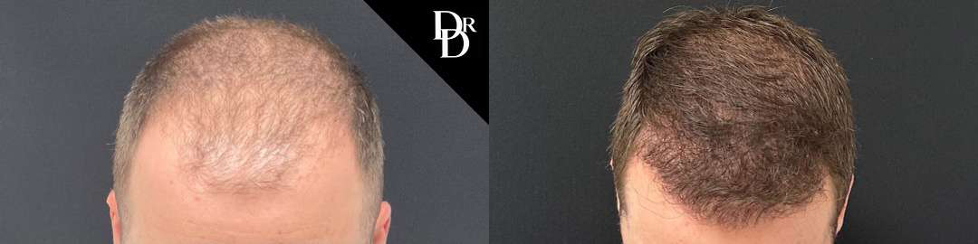 Hair Transplant Before And After Photos By Dr. Demetri Arnaoutakis In Tampa, Fl