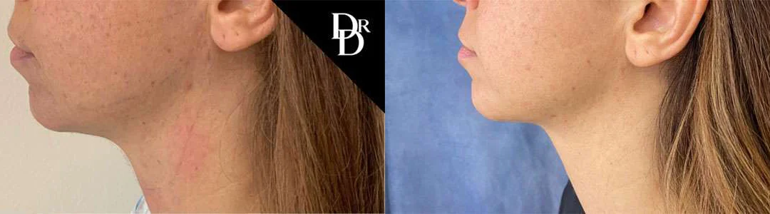 Neck Lift Before And After Photos By Dr. Demetri Arnaoutakis In Tampa, Fl