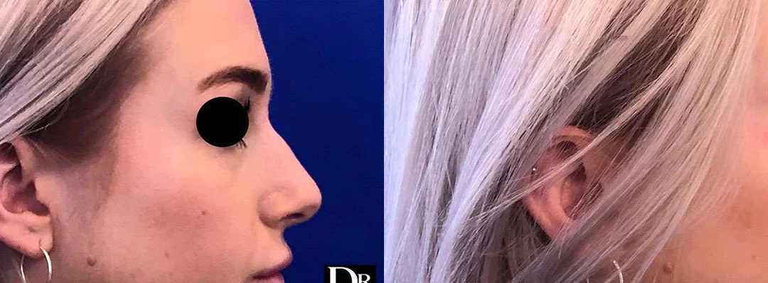 Rhinoplasty before and after photos by Dr. Demetri Arnaoutakis in Tampa, FL