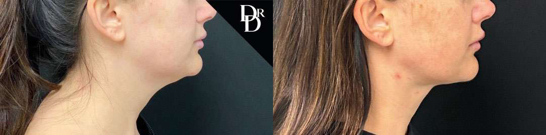 Neck Lift before and after photos by Dr. Demetri Arnaoutakis in Tampa, FL
