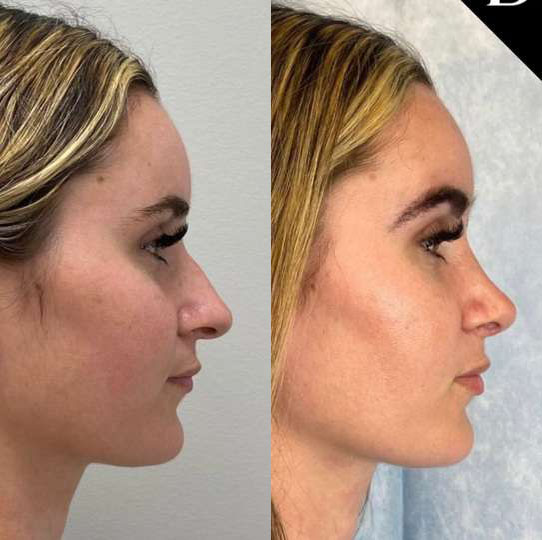 Rhinoplasty before and after photos by Dr. Demetri Arnaoutakis in Tampa, FL