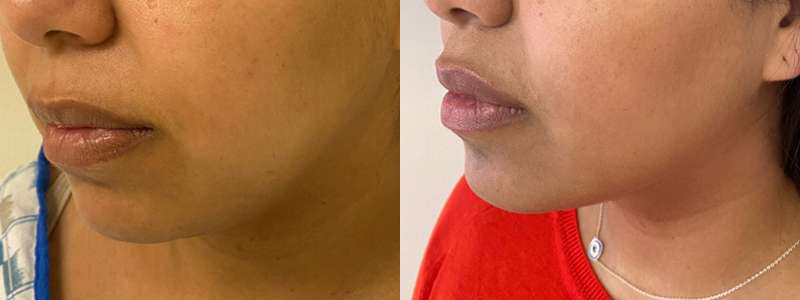 Buccal Fat Pad Removal before and after photos by Dr. Demetri Arnaoutakis in Tampa, FL