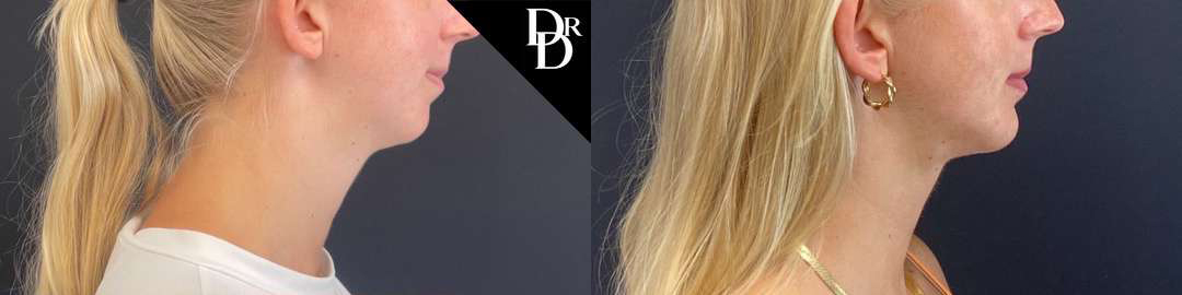 Chin Augmentation before and after photos by Dr. Demetri Arnaoutakis in Tampa, FL