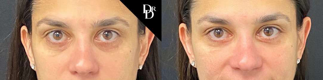 Eyelid Surgery before and after photos by Dr. Demetri Arnaoutakis in Tampa, FL