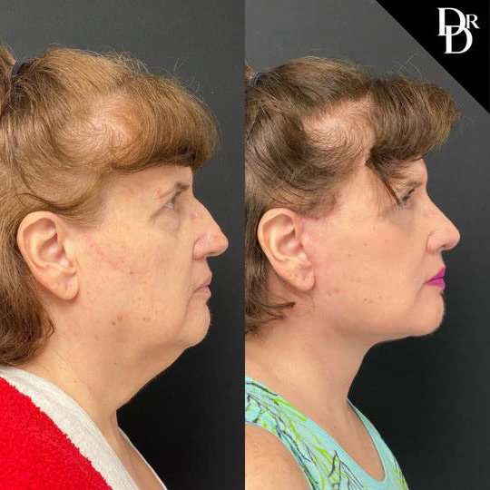 Facelift Before And After Photos By Dr. Demetri Arnaoutakis In Tampa, Fl