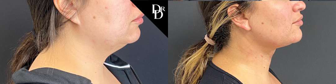 Facetite Before And After Photos By Dr. Demetri Arnaoutakis In Tampa, Fl