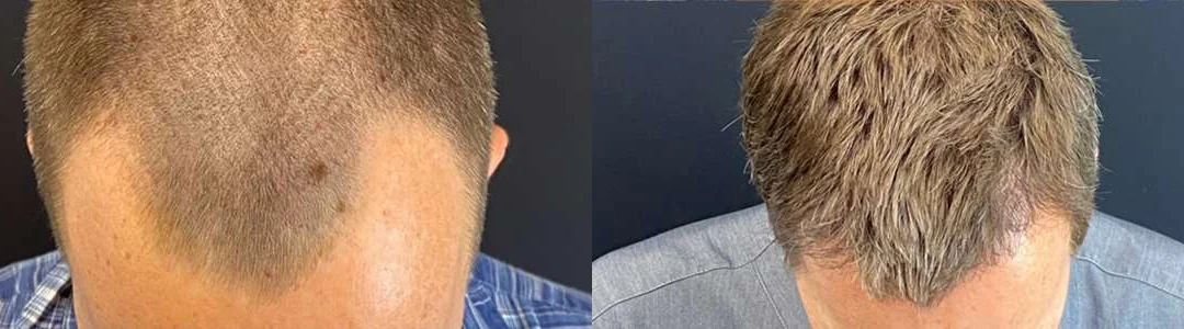 Hair Transplant Before And After Photos By Dr. Demetri Arnaoutakis In Tampa, Fl