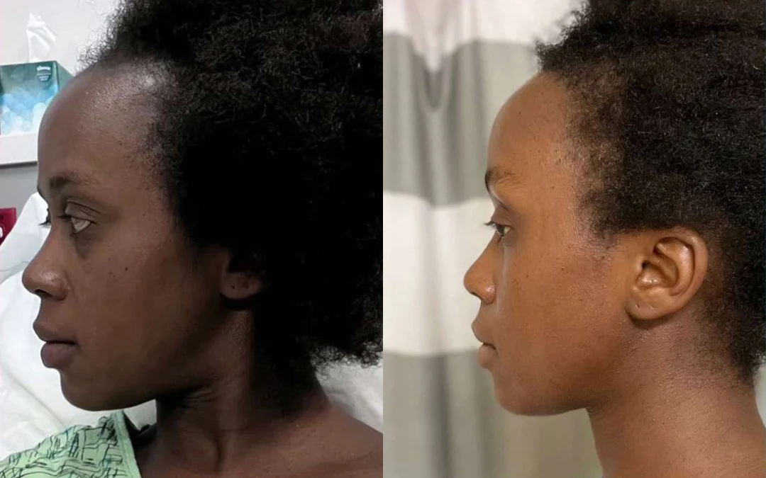 Hairline Lowering Surgery Before And After Photos By Dr. Demetri Arnaoutakis In Tampa, Fl