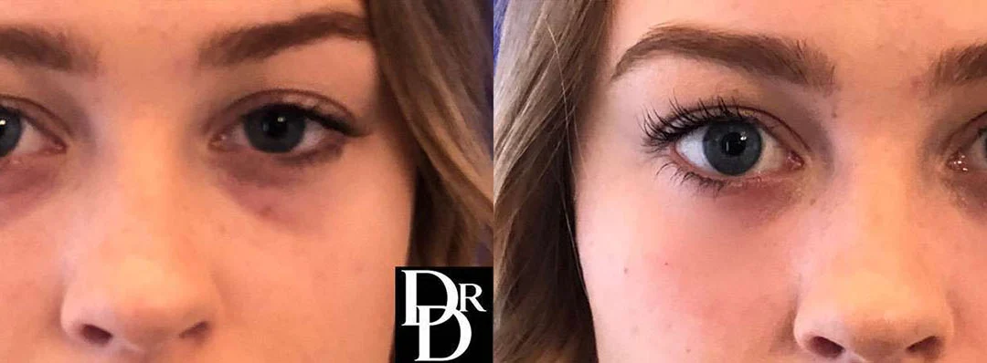 Injectable/Dermal Fillers Before And After Photos By Dr. Demetri Arnaoutakis In Tampa, Fl