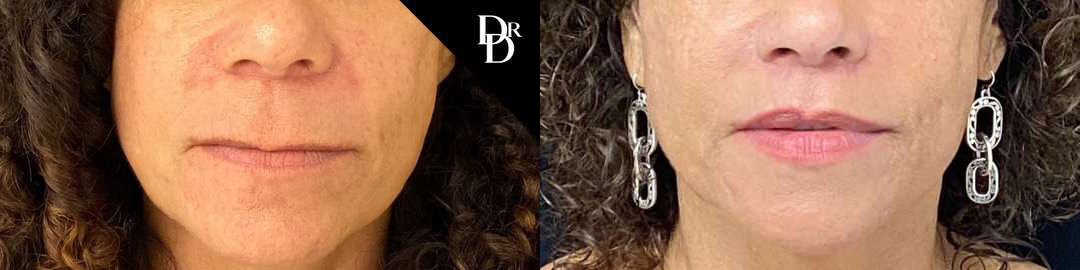 Lip Lift before and after photos by Dr. Demetri Arnaoutakis in Tampa, FL