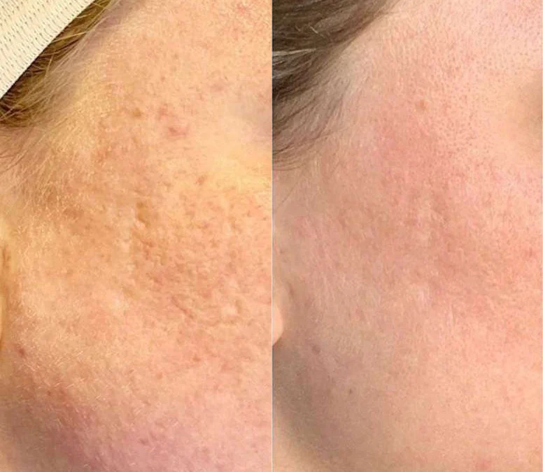 Microneedling Before And After Photos By Dr. Demetri Arnaoutakis In Tampa, Fl