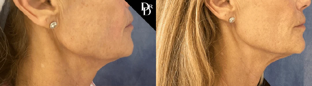Morpheus8 Before And After Photos By Dr. Demetri Arnaoutakis In Tampa, Fl