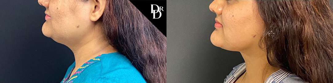 Neck Lift Before And After Photos By Dr. Demetri Arnaoutakis In Tampa, Fl