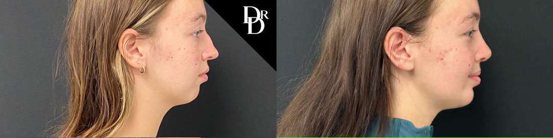 Rhinoplasty before and after photos by Dr. Demetri Arnaoutakis in Tampa, FL