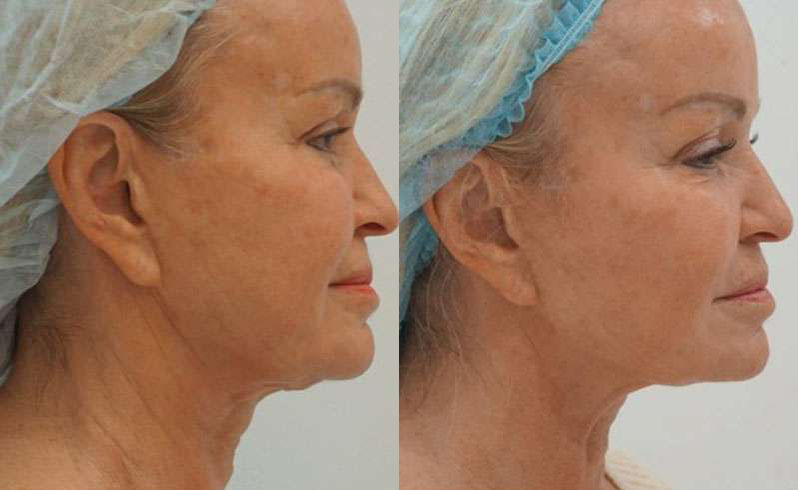 Sofwave Before And After Photos By Dr. Demetri Arnaoutakis In Tampa, Fl