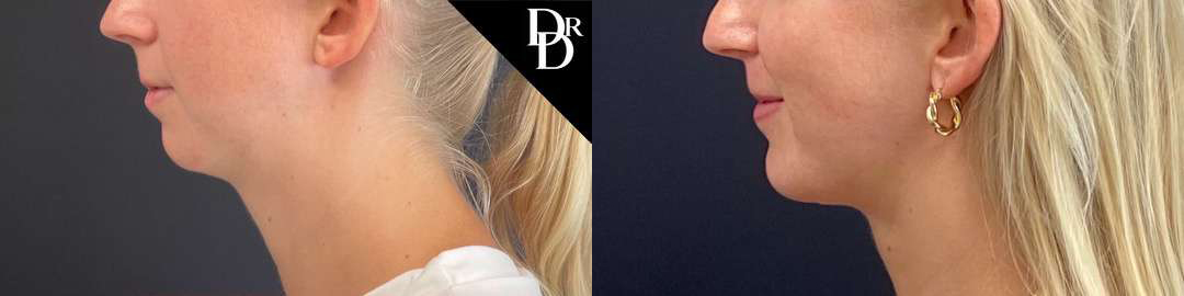Chin Augmentation Before And After Photos By Dr. Demetri Arnaoutakis In Tampa, Fl
