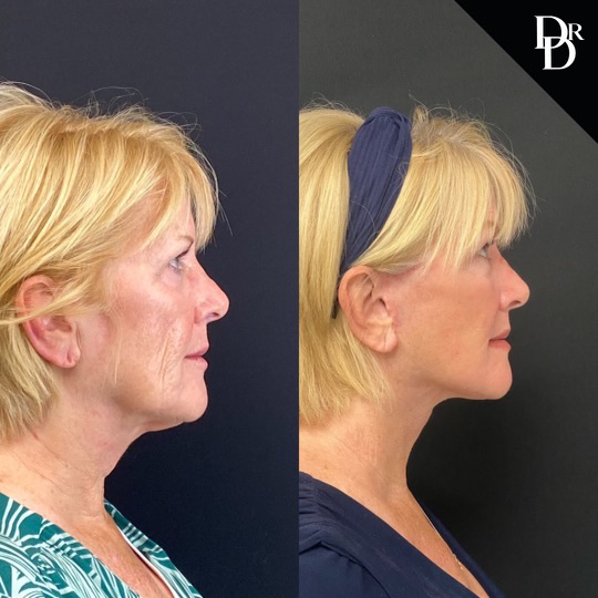 Facelift Before And After Photos By Dr. Demetri Arnaoutakis In Tampa, Fl