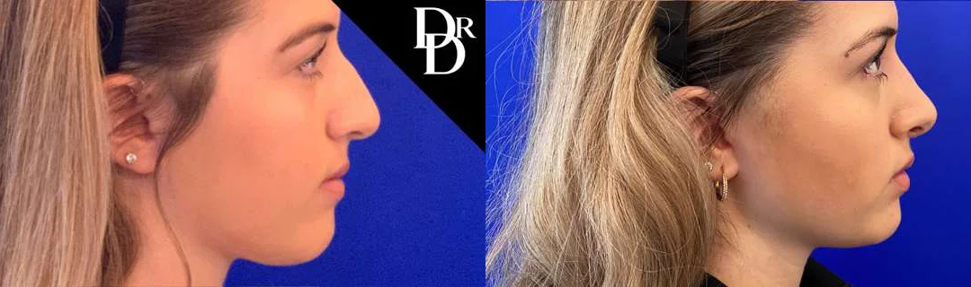 Rhinoplasty before and after photos by Dr. Demetri Arnaoutakis in Tampa, FL
