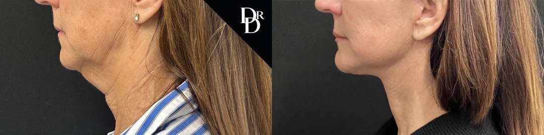 Facelift Before And After Photos By Dr. Demetri Arnaoutakis In Tampa, Fl