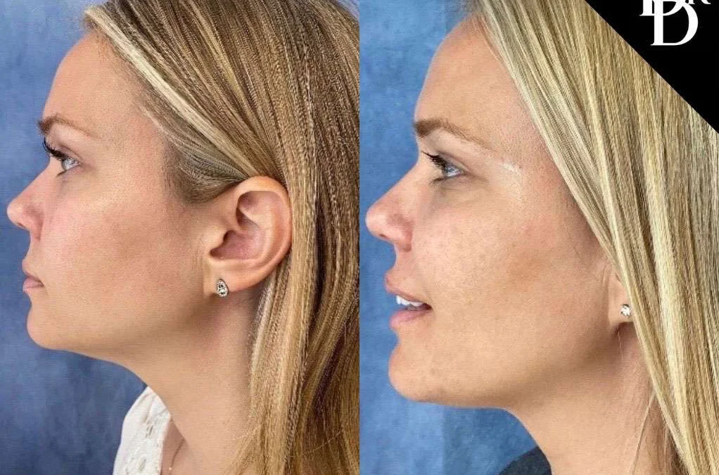 Facetite Before And After Photos By Dr. Demetri Arnaoutakis In Tampa, Fl