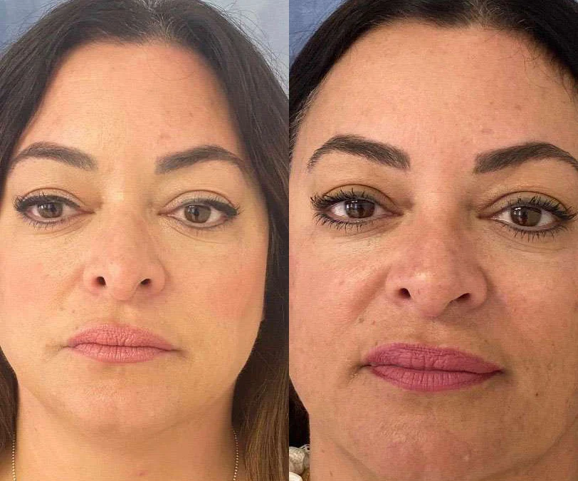 Rhinoplasty before and after photos by Dr. Demetri Arnaoutakis in Tampa, FL