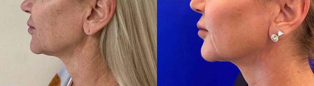 Facetite Before And After Photos By Dr. Demetri Arnaoutakis In Tampa, Fl