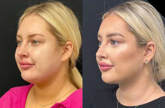 Neck Lift before and after photos by Dr. Demetri Arnaoutakis in Tampa, FL