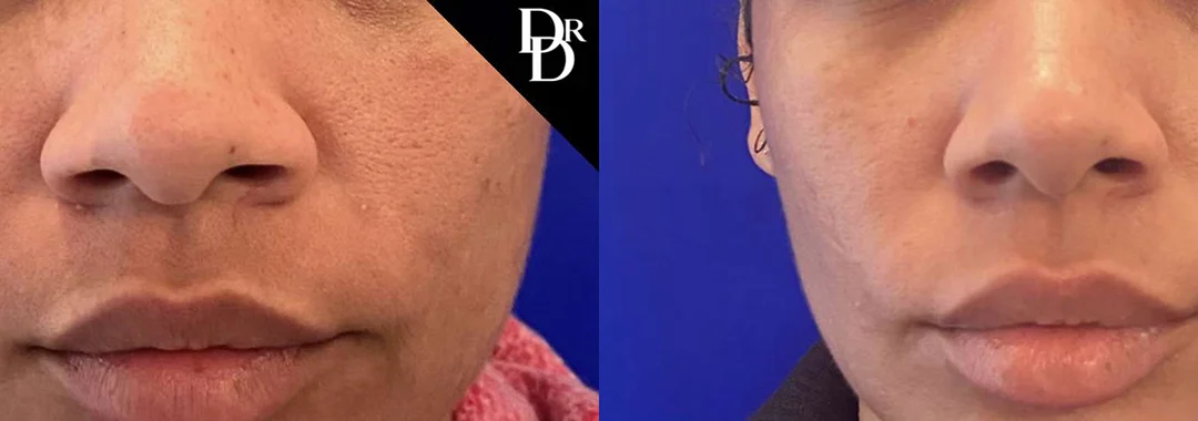Rhinoplasty before and after photos by Dr. Demetri Arnaoutakis in Tampa, FL