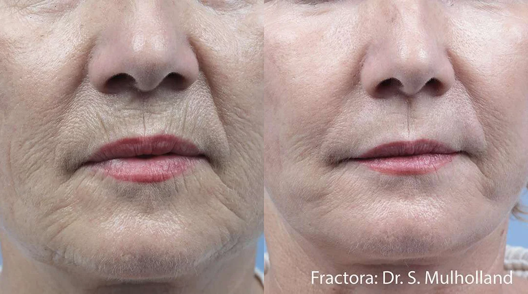 Facetite Before And After Photos By Dr. Demetri Arnaoutakis In Tampa, Fl