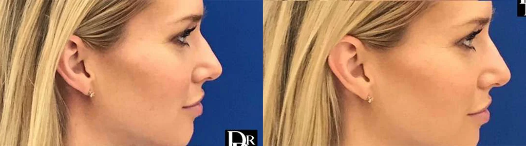 Rhinoplasty before and after photos by Dr. Demetri Arnaoutakis in Tampa, FL