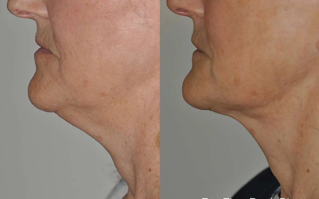 Facetite Before And After Photos By Dr. Demetri Arnaoutakis In Tampa, Fl
