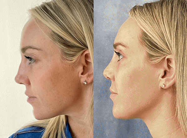 Rhinoplasty Before And After Photos By Dr. Demetri Arnaoutakis In Tampa, Fl