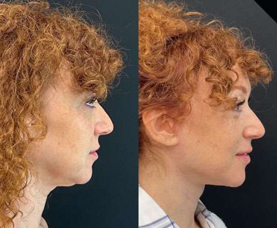 Facelift Before And After Photos By Dr. Demetri Arnaoutakis In Tampa, Fl