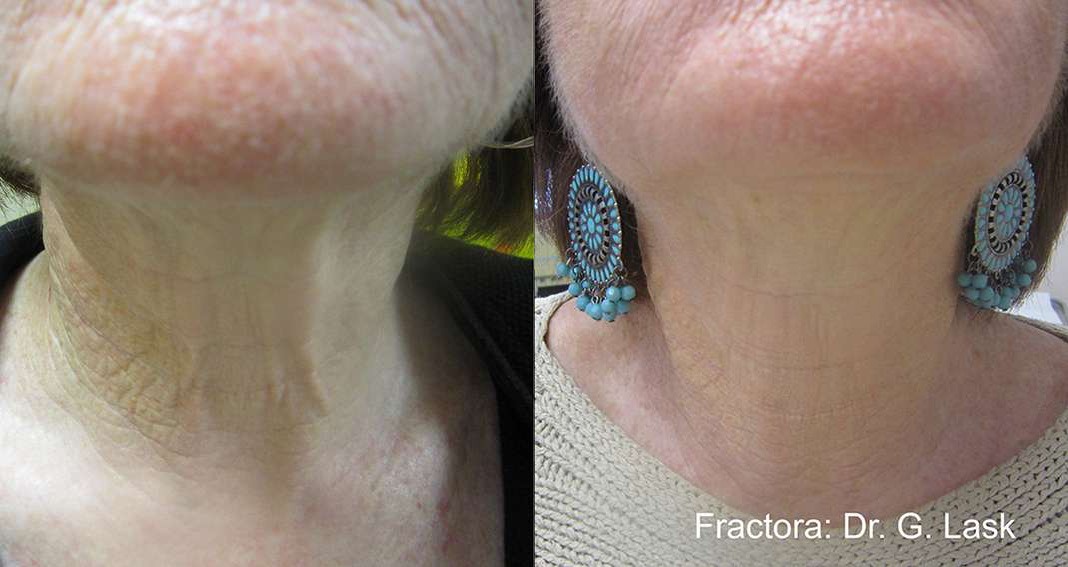 Facetite Before And After Photos By Dr. Demetri Arnaoutakis In Tampa, Fl