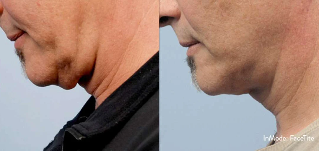 Facetite Before And After Photos By Dr. Demetri Arnaoutakis In Tampa, Fl
