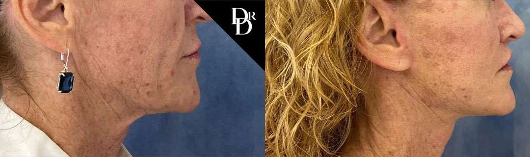 Neck Lift before and after photos by Dr. Demetri Arnaoutakis in Tampa, FL